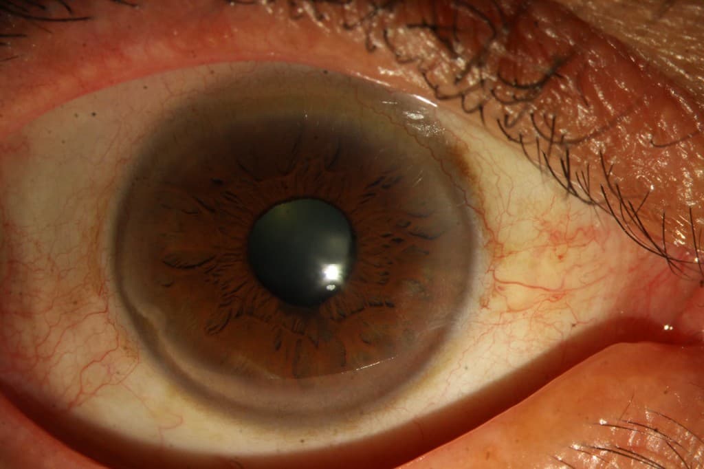 Example of a good eye photo for diabetes screening — clear, close-up, well-lit.